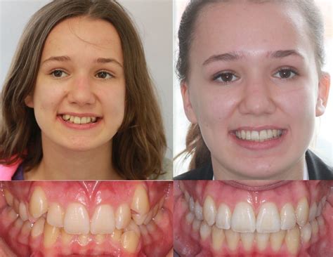 The Future of Teeth Straightening: Magic Teeth Brace Reviews